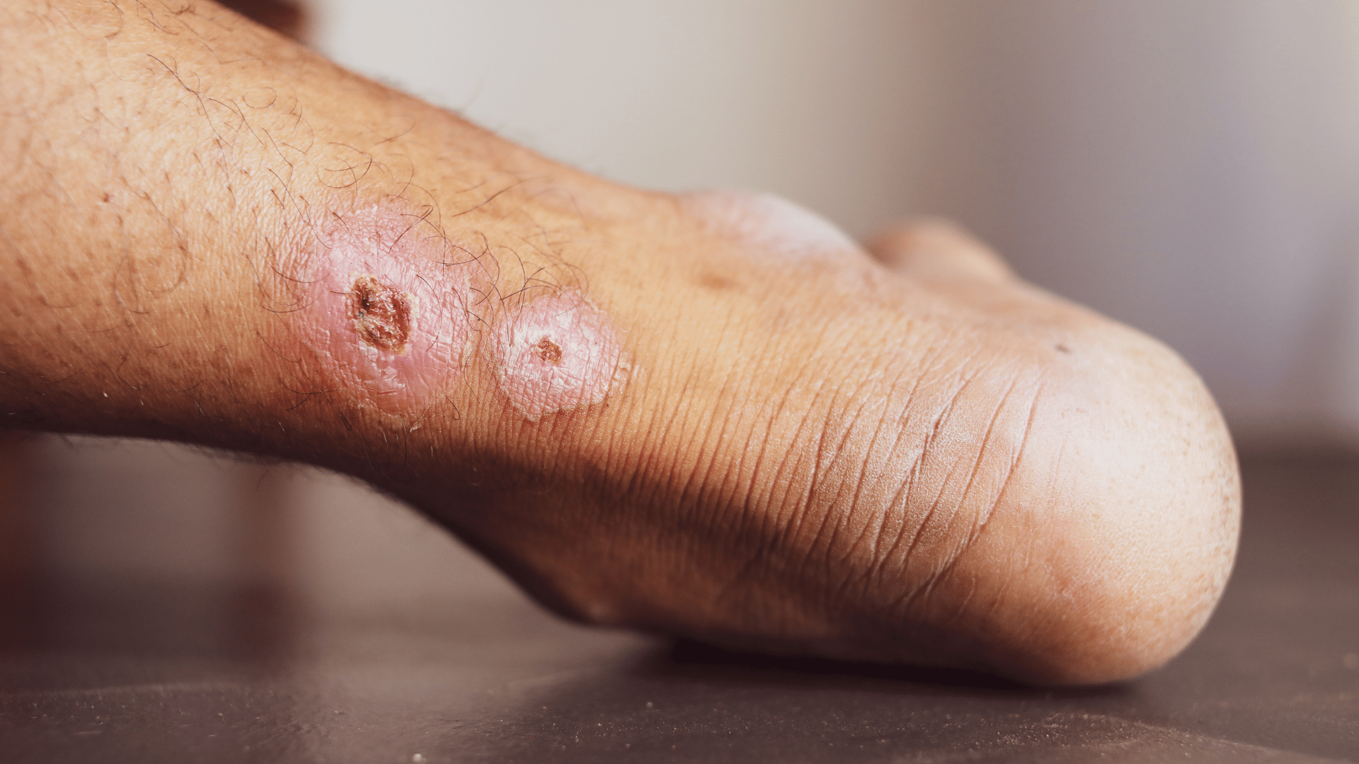 Important Facts About Foot Ulcers