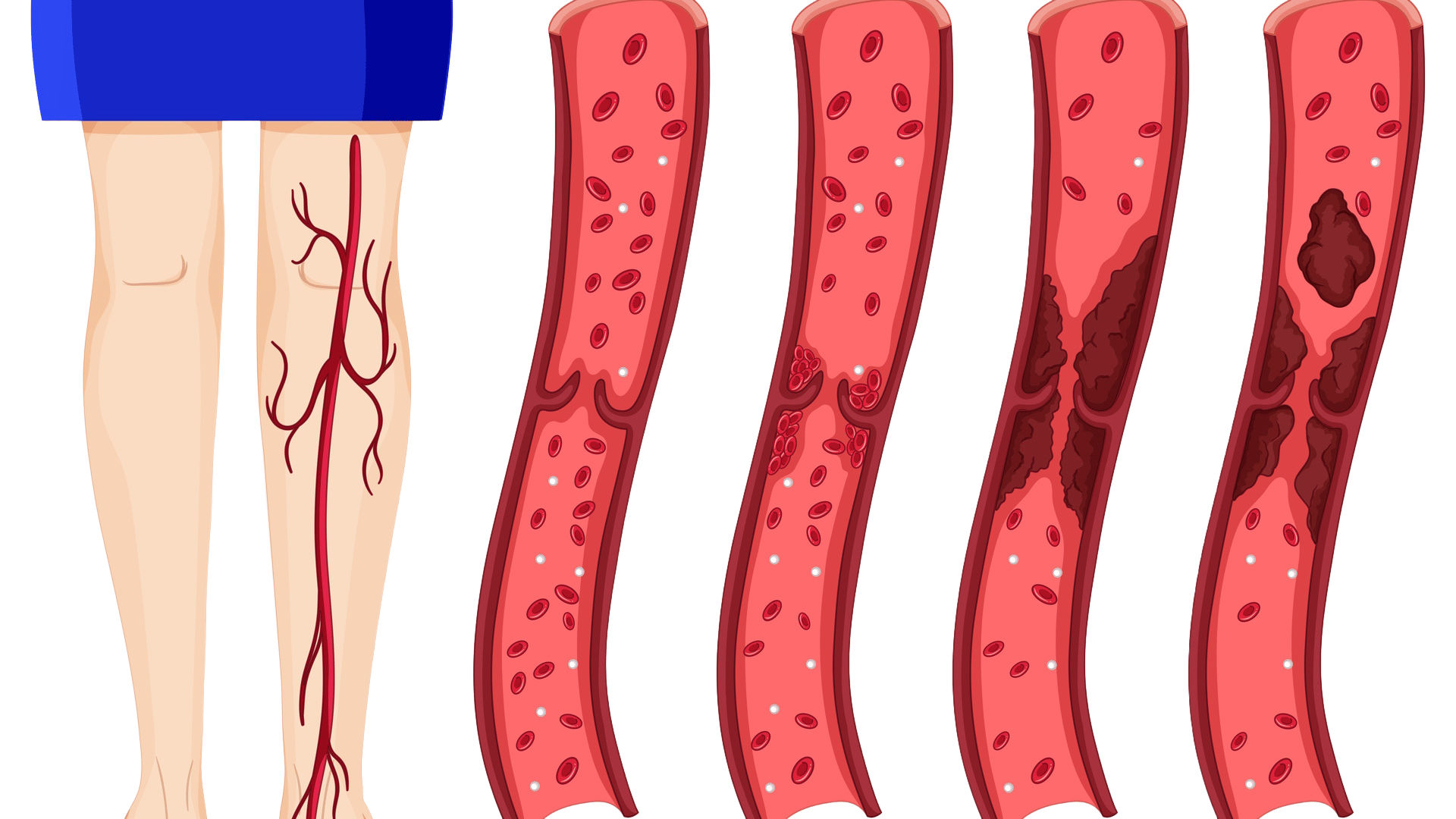 What are Varicose Veins and How to Prevent Them